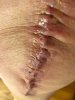 [Bonesmart.org] Knee Scars - Post Your Badges of Honor Here! NO CHIT-CHAT please