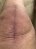 [Bonesmart.org] Knee Scars - Post Your Badges of Honor Here! NO CHIT-CHAT please