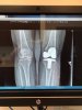 [Bonesmart.org] Success story