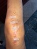 [Bonesmart.org] Knee Scars - Post Your Badges of Honor Here! NO CHIT-CHAT please