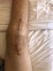 [Bonesmart.org] Kurt_H's Knee Infection