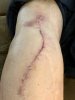[Bonesmart.org] Knee Scars - Post Your Badges of Honor Here! NO CHIT-CHAT please