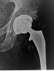 [Bonesmart.org] Hip Pain 1 Year After THR