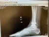 [Bonesmart.org] My total ankle replacement story
