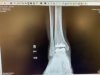[Bonesmart.org] My total ankle replacement story