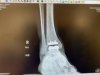 [Bonesmart.org] My total ankle replacement story