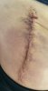 [Bonesmart.org] Hippies scars - post your badges of honor here: NO CHIT-CHAT HERE PLEASE