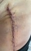 [Bonesmart.org] Hippies scars - post your badges of honor here: NO CHIT-CHAT HERE PLEASE