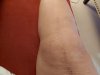 [Bonesmart.org] Grandma Chris gets a new knee!