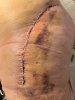[Bonesmart.org] Hippies scars - post your badges of honor here: NO CHIT-CHAT HERE PLEASE