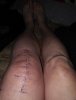 [Bonesmart.org] Knee Scars - Post Your Badges of Honor Here! NO CHIT-CHAT please