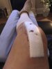 [Bonesmart.org] Knee Scars - Post Your Badges of Honor Here! NO CHIT-CHAT please