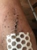 [Bonesmart.org] Knee Scars - Post Your Badges of Honor Here! NO CHIT-CHAT please