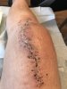 [Bonesmart.org] Knee Scars - Post Your Badges of Honor Here! NO CHIT-CHAT please