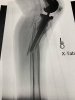 [Bonesmart.org] Tibia break after knee revision