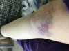 [Bonesmart.org] Greda's recovery story<<