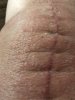 [Bonesmart.org] Total Left Knee Replacement