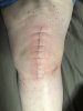 [Bonesmart.org] Total Left Knee Replacement