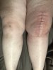 [Bonesmart.org] Total Left Knee Replacement
