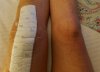 [Bonesmart.org] Makoplasty: ongoing pain<