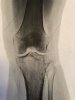 [Bonesmart.org] Constant pain continuing 1 year after THR<^