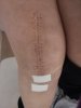[Bonesmart.org] Knee Scars - Post Your Badges of Honor Here! NO CHIT-CHAT please
