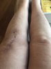 [Bonesmart.org] Knee Scars - Post Your Badges of Honor Here! NO CHIT-CHAT please