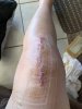 [Bonesmart.org] Knee Scars - Post Your Badges of Honor Here! NO CHIT-CHAT please