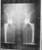 [Bonesmart.org] BoneSmart = best recovery!