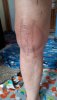 [Bonesmart.org] Knee Scars - Post Your Badges of Honor Here! NO CHIT-CHAT please