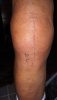 [Bonesmart.org] Knee Scars - Post Your Badges of Honor Here! NO CHIT-CHAT please