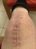 [Bonesmart.org] Knee Scars - Post Your Badges of Honor Here! NO CHIT-CHAT please