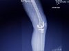 [Bonesmart.org] Makoplasty: ongoing pain<