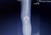 [Bonesmart.org] Makoplasty: ongoing pain<
