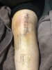 [Bonesmart.org] Knee Scars - Post Your Badges of Honor Here! NO CHIT-CHAT please
