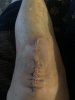 [Bonesmart.org] Knee Scars - Post Your Badges of Honor Here! NO CHIT-CHAT please