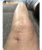 [Bonesmart.org] Knee Scars - Post Your Badges of Honor Here! NO CHIT-CHAT please