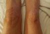 [Bonesmart.org] Makoplasty: ongoing pain<