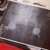[Bonesmart.org] 5 Weeks Pain<