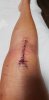 [Bonesmart.org] Knee Scars - Post Your Badges of Honor Here! NO CHIT-CHAT please