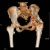 [Bonesmart.org] Developed Heterotopic Ossification in Left Hip