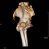 [Bonesmart.org] Developed Heterotopic Ossification in Left Hip