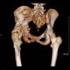 [Bonesmart.org] Developed Heterotopic Ossification in Left Hip