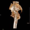 [Bonesmart.org] Developed Heterotopic Ossification in Left Hip