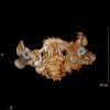 [Bonesmart.org] Developed Heterotopic Ossification in Left Hip