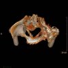 [Bonesmart.org] Developed Heterotopic Ossification in Left Hip