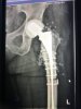 [Bonesmart.org] Hippies scars - post your badges of honor here: NO CHIT-CHAT HERE PLEASE