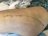 [Bonesmart.org] Hippies scars - post your badges of honor here: NO CHIT-CHAT HERE PLEASE