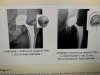 [Bonesmart.org] Life After SCaprae