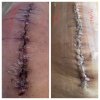 [Bonesmart.org] Knee Scars - Post Your Badges of Honor Here! NO CHIT-CHAT please